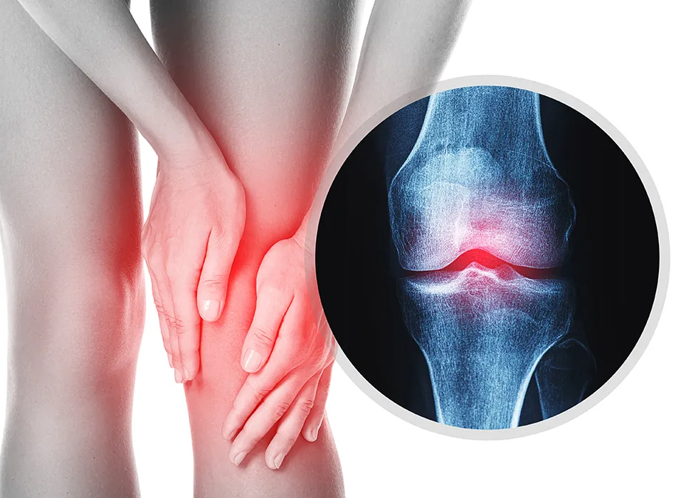 変形膝関節症のイメージ